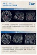 二级胶质瘤能活20年吗？为什么会