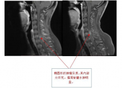 脊髓髓内肿瘤治疗方案附案例一